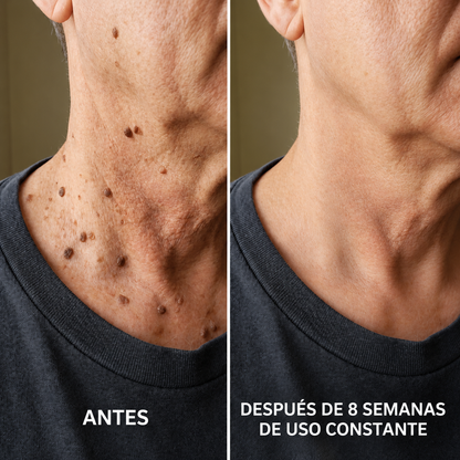 Crema queratolítica avanzada para piel áspera y elevada